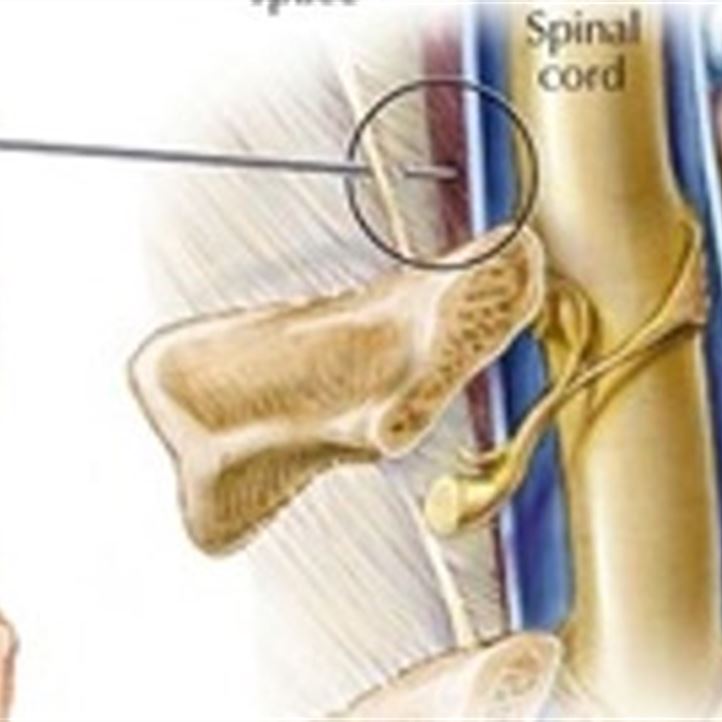 epidural blockad